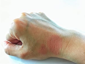 shutterstock_1164945673- Lupus-hand